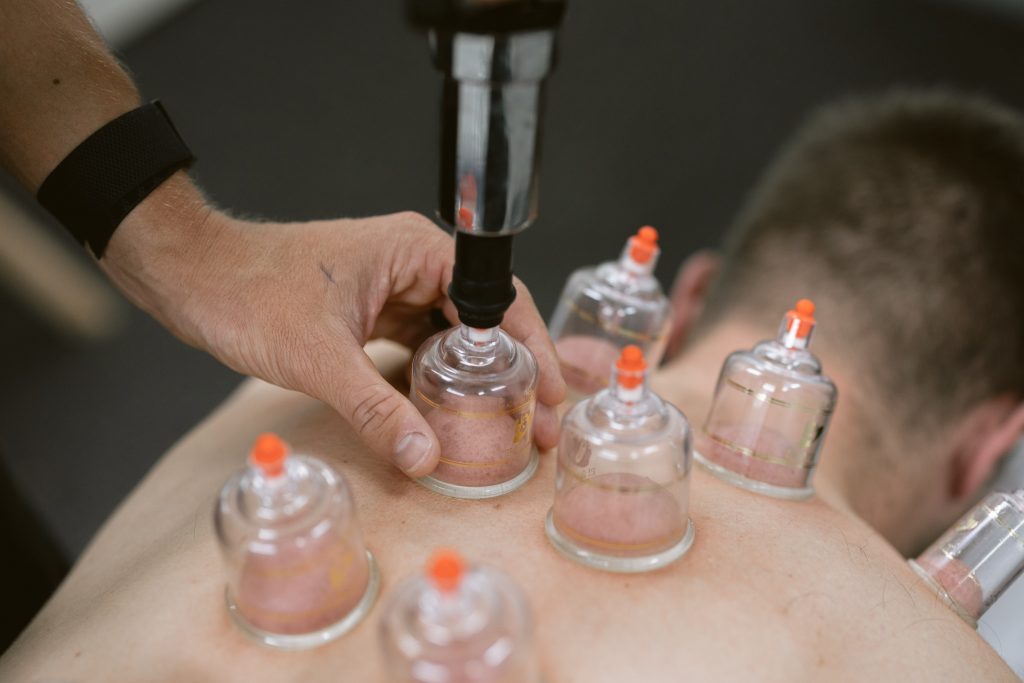 Chiropractor using Cupping Therapy at Impulse Chiropractic