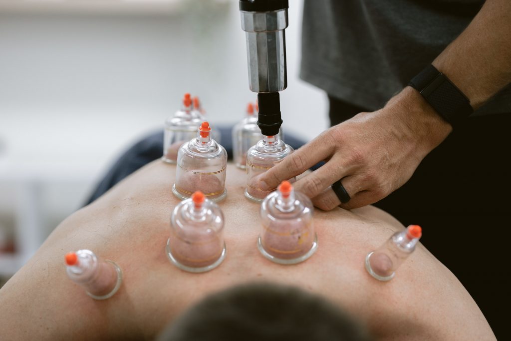 Chiropractor using Cupping Therapy at Impulse Chiropractic