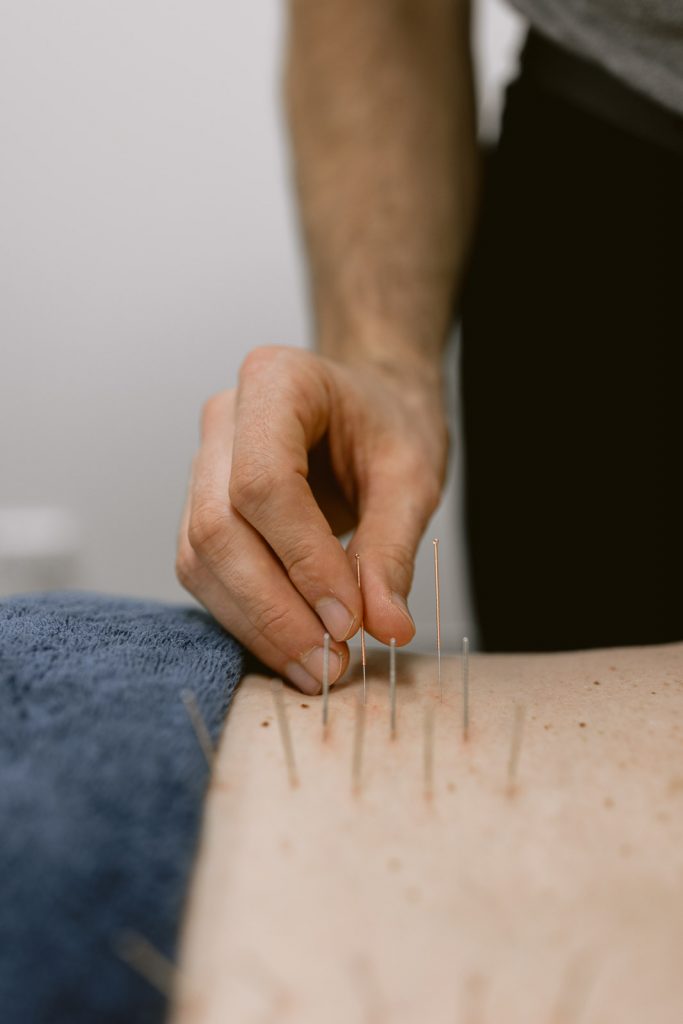 Chiropractor using Dry Needles at Impulse Chiropractic