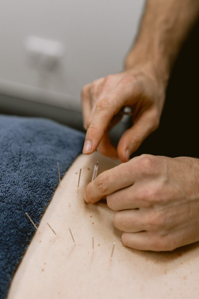 Chiropractor using Dry Needles at Impulse Chiropractic